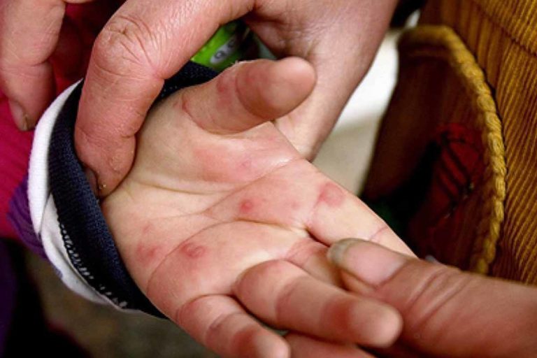 මොකද්ද මේ Hand-foot and Mouth Disease කියන්නේ…
